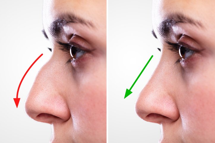 Cosmetic Surgery for the Nose